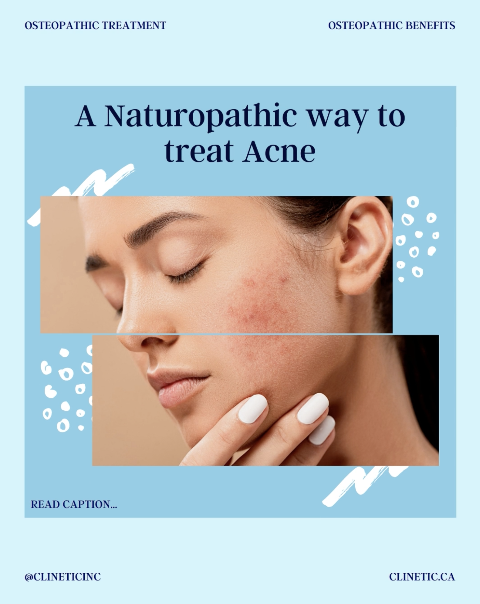 A Naturopathic way to treat Acne
