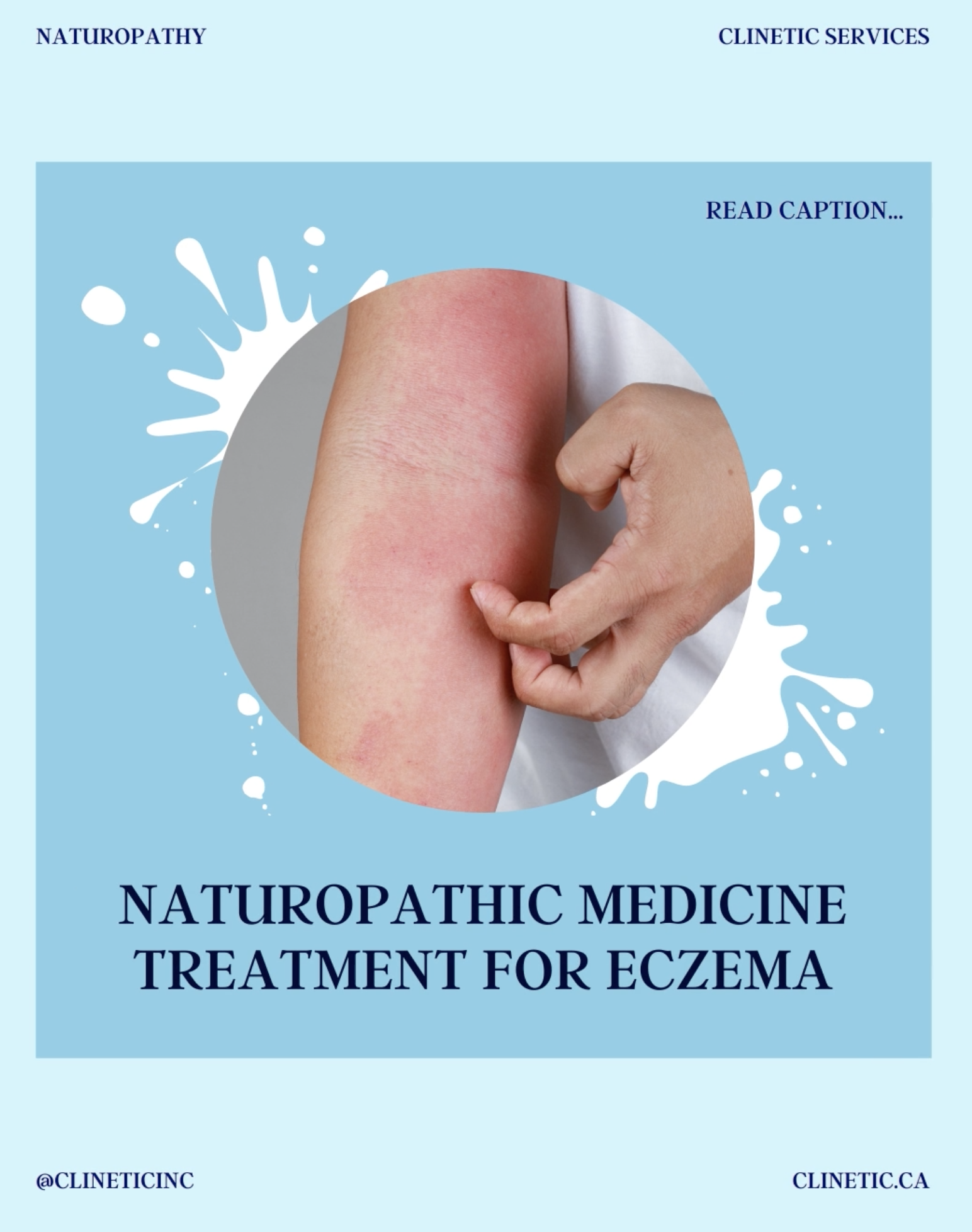 Naturopathic medicine treatment for Eczema