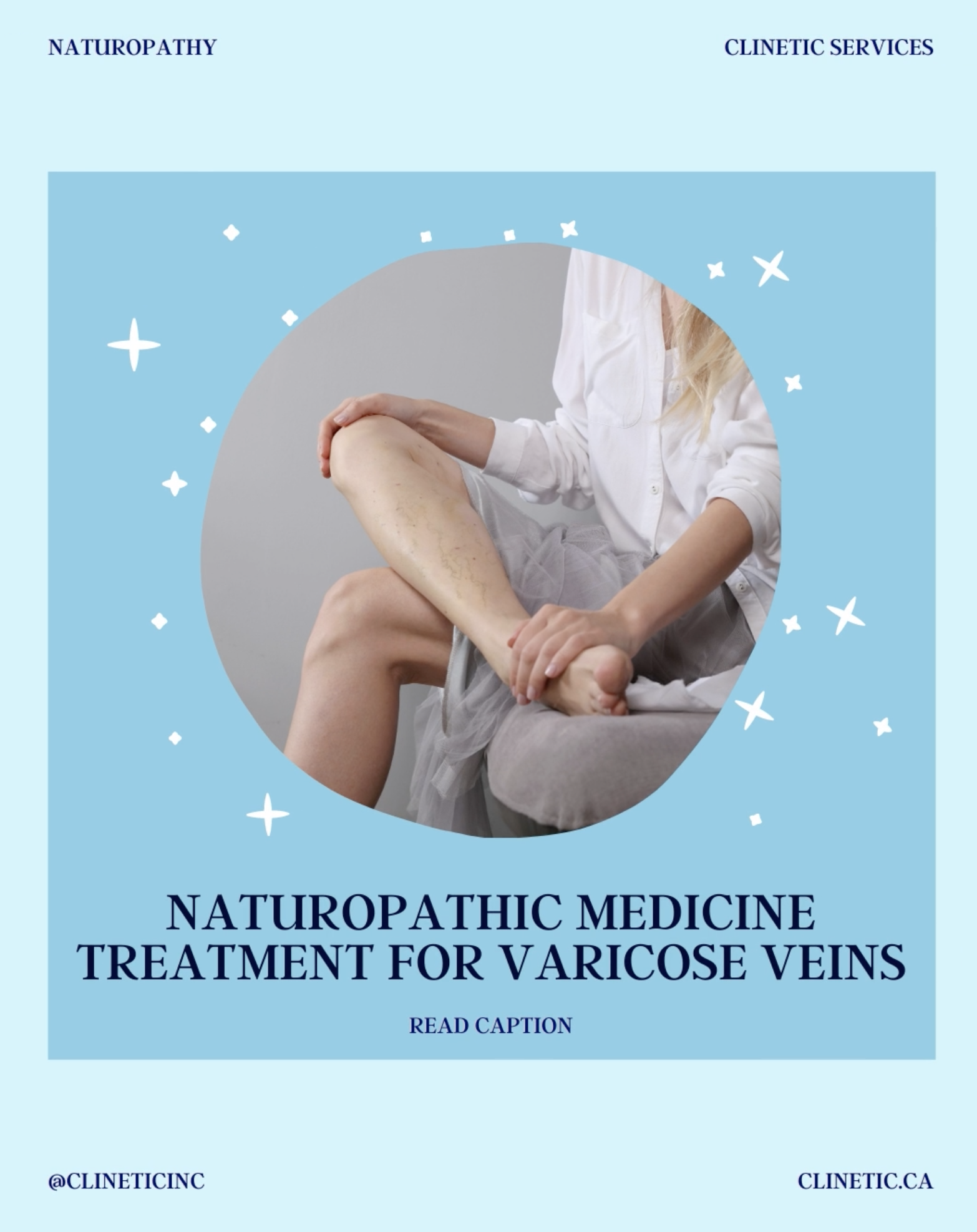 Naturopathic medicine treatment for Varicose Veins